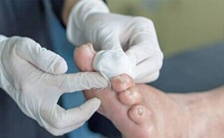 راهاندازی و فعالیت مرکز پلاسمادرمانی زخمهای دیابتی در بیمارستان امام علی (ع) کرج